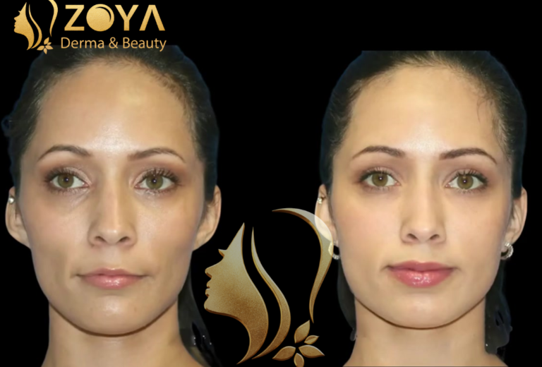 حقن الدهون الذاتيه للوجه