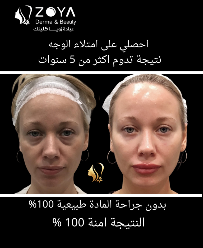 حقن الدهون الذاتية للوجه