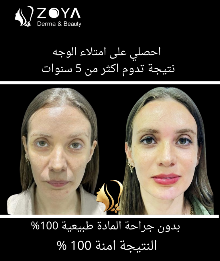 حقن دهون الوجه