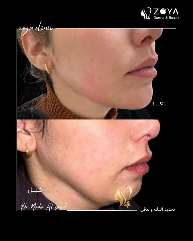 فيلر الشفايف وكنتور الوجه