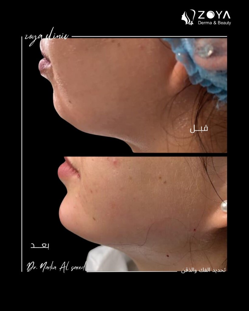 فيلر الشفايف وكنتور الوجه