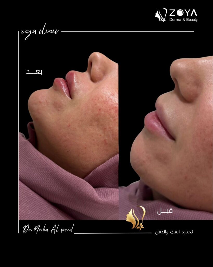 فيلر الشفايف وكنتور الوجه