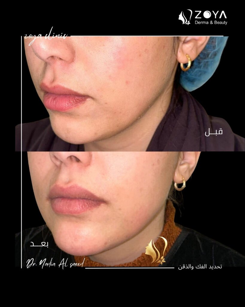 فيلر الشفايف وكنتور الوجه