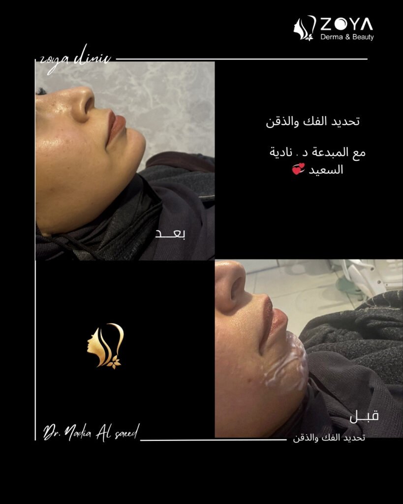 فيلر الشفايف وكنتور الوجه