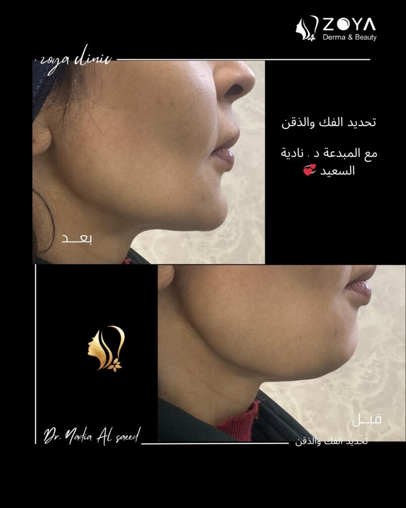 فيلر الشفايف والذقن