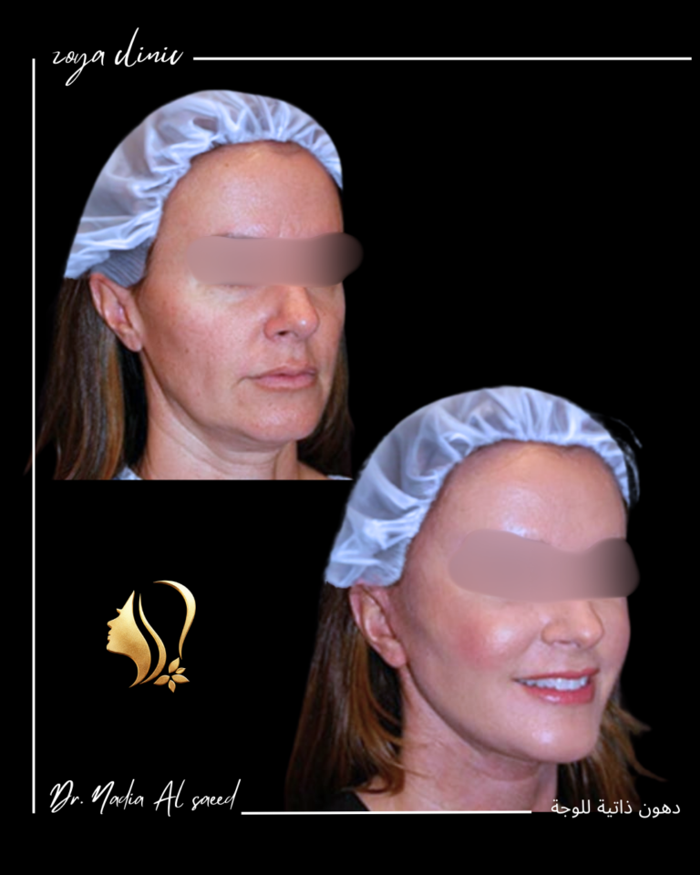 حقن دهون ذاتية للوجة