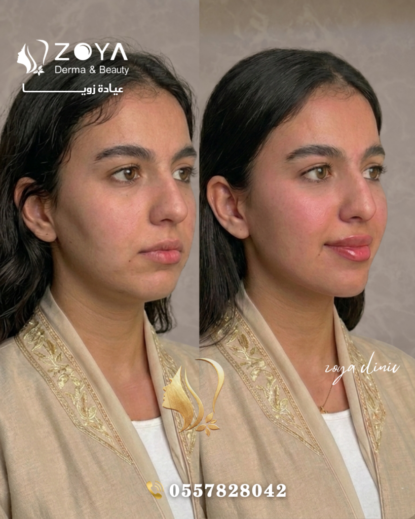 فيلر الشفايف وكنتور الوجة