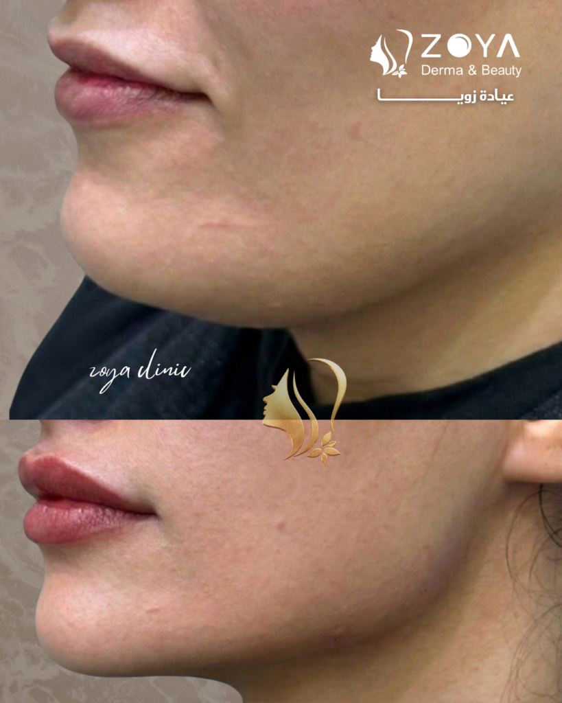 فيلر الشفايف وكنتور الوجة