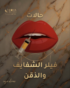 فيلر الشفايف