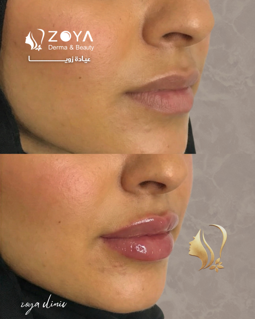 فيلر الشفايف افضل فيلر شفايف في عيادة زويا