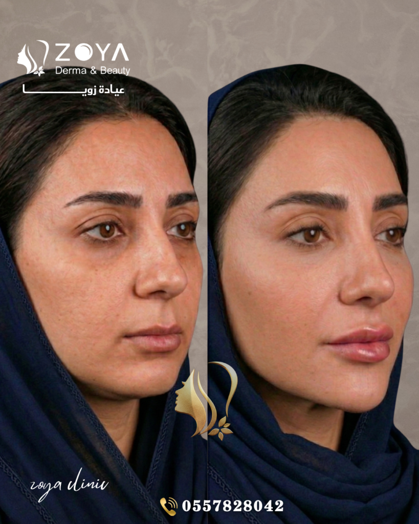 فيلر الشفايف وكنتور اوجه