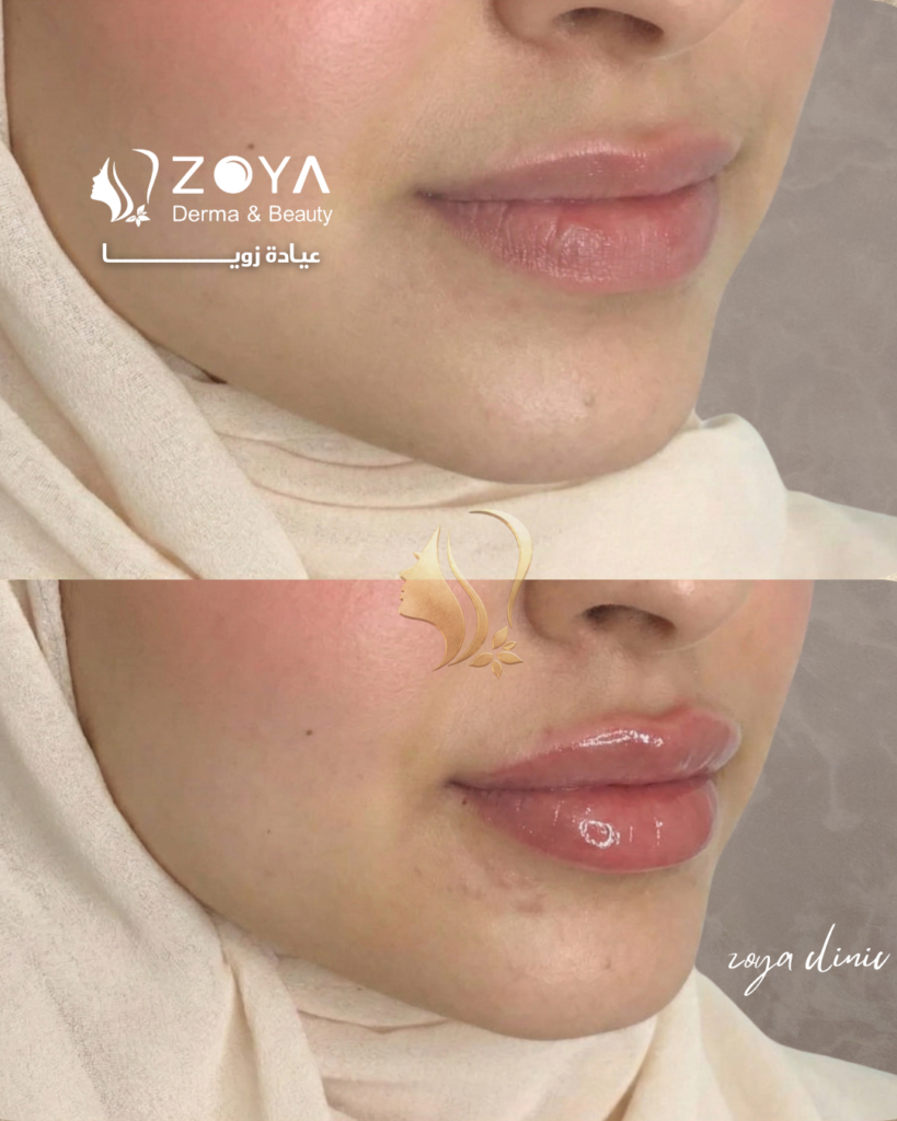 فيلر شفايف افضل انواع فيلر الشفايف