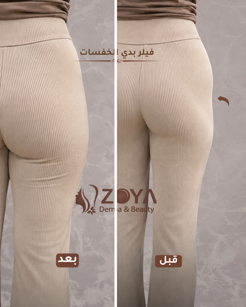 فيلر الخفسات تكببير المؤخره
