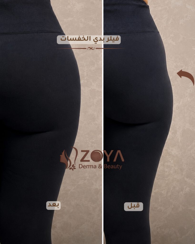 فيلر الخفسات تكببير المؤخره